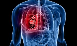 lung cancer
