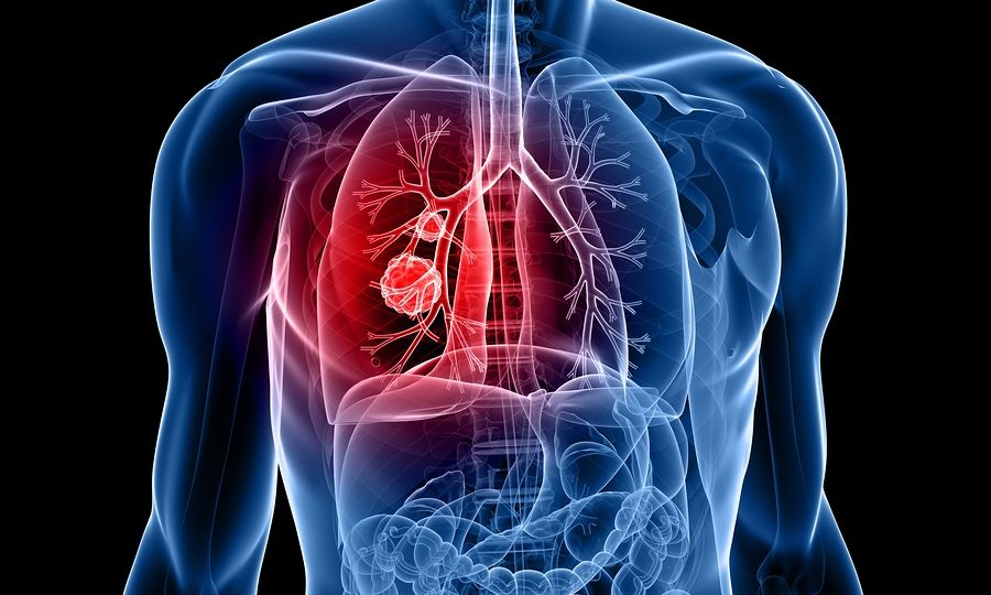 lung cancer